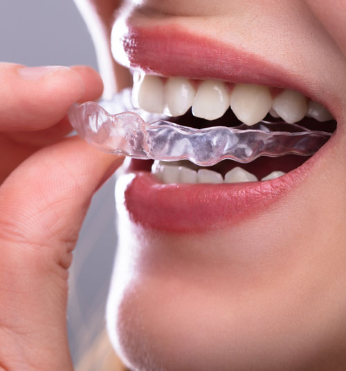 A Woman's Hand Putting Transparent Aligner In Teeth