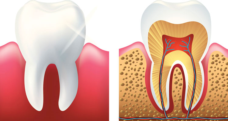 Root canal illustration