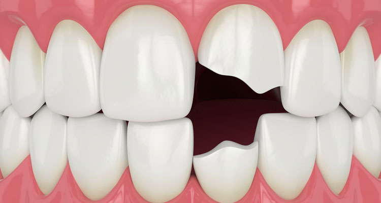 Broken teeth illustration