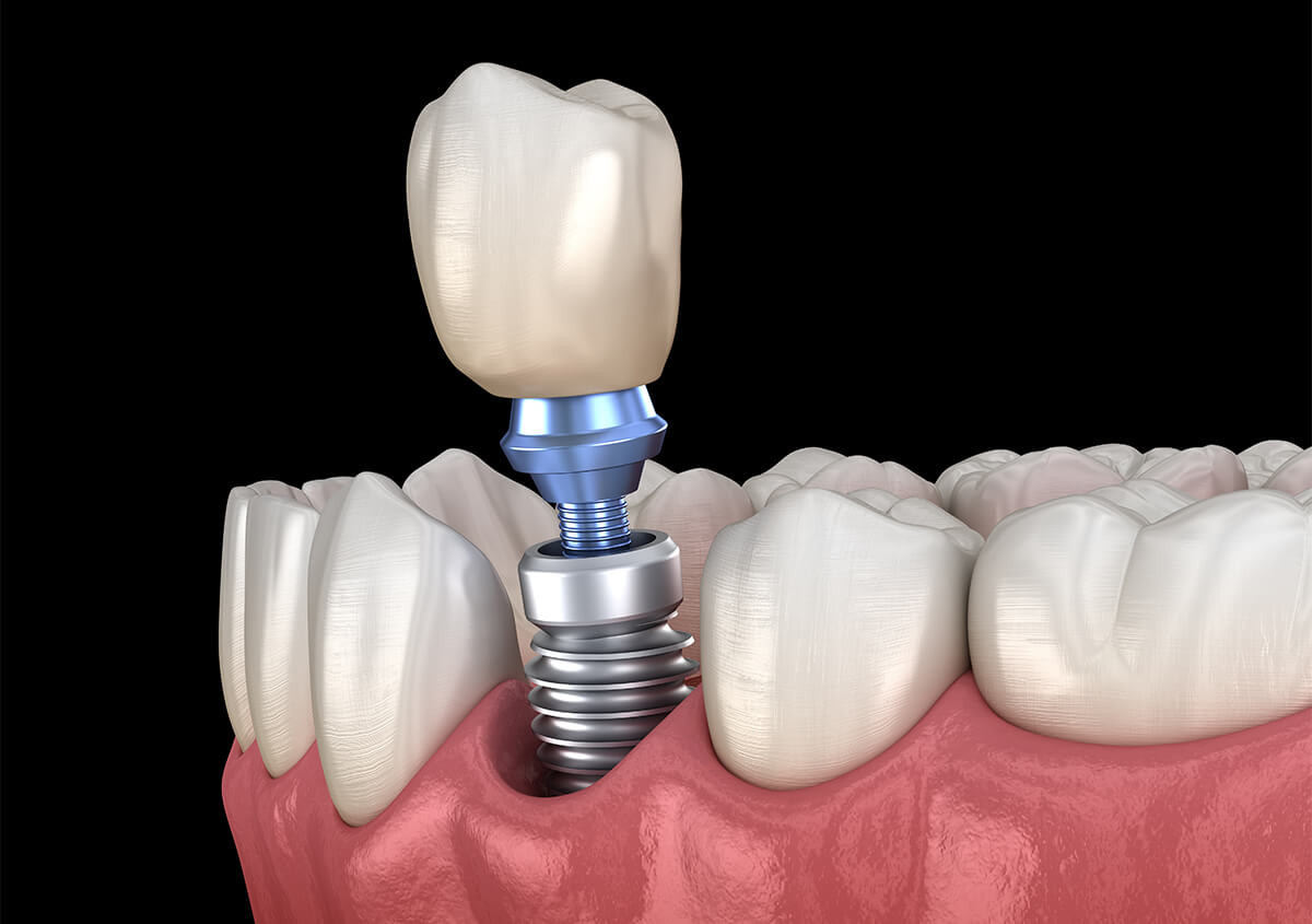 Dental Implant Dentist in Prescott WI Area