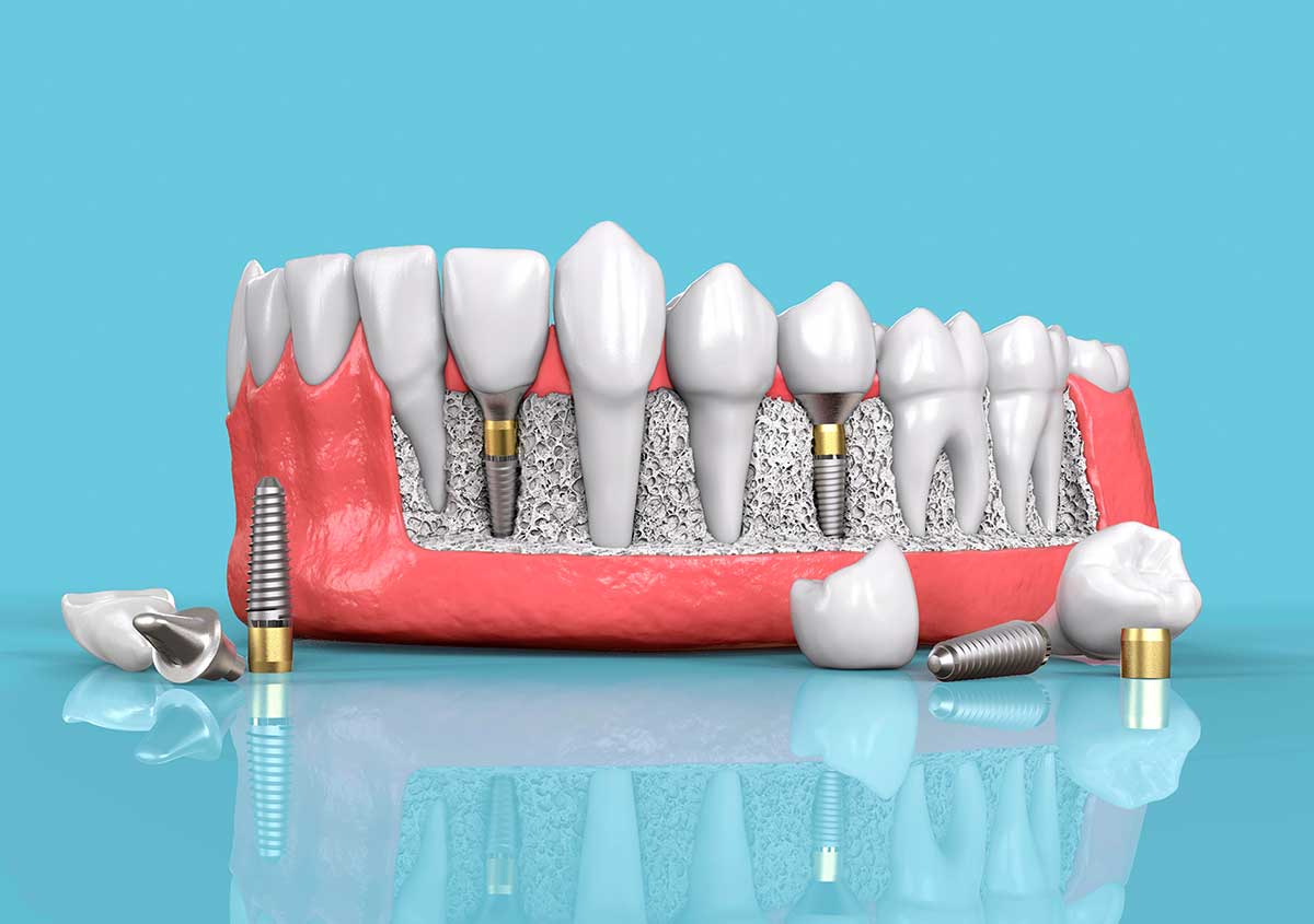 Good Dental Implants in Prescott WI Area